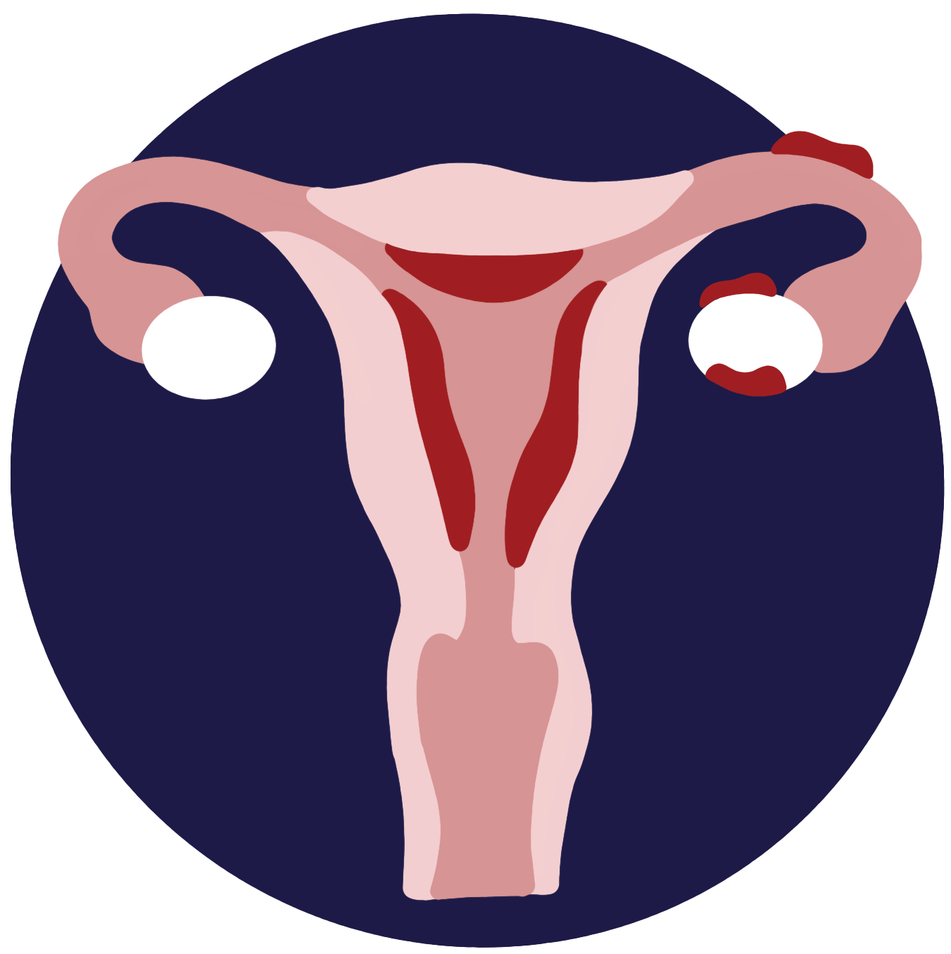 adenomyosis & endometriosis
