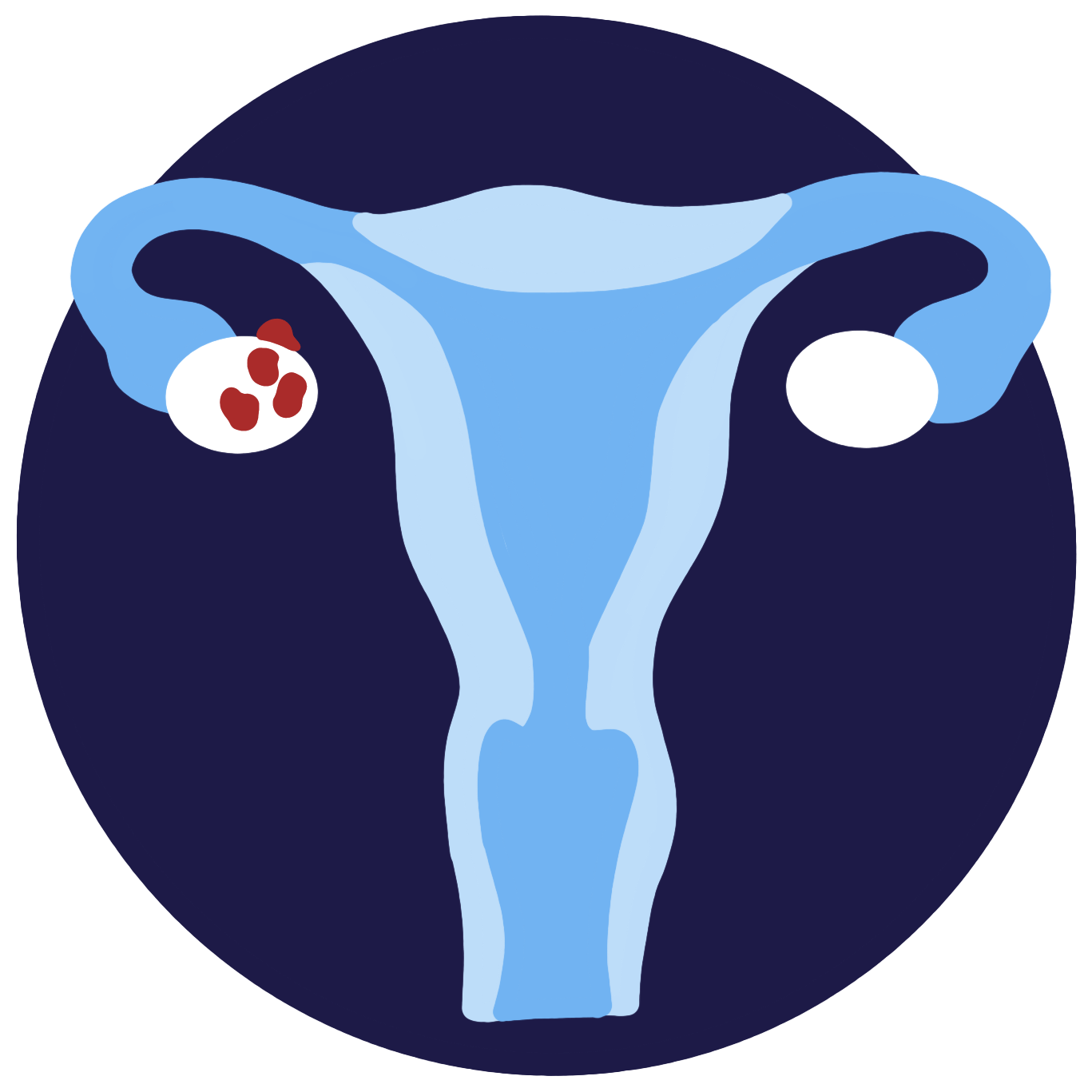 PCOS